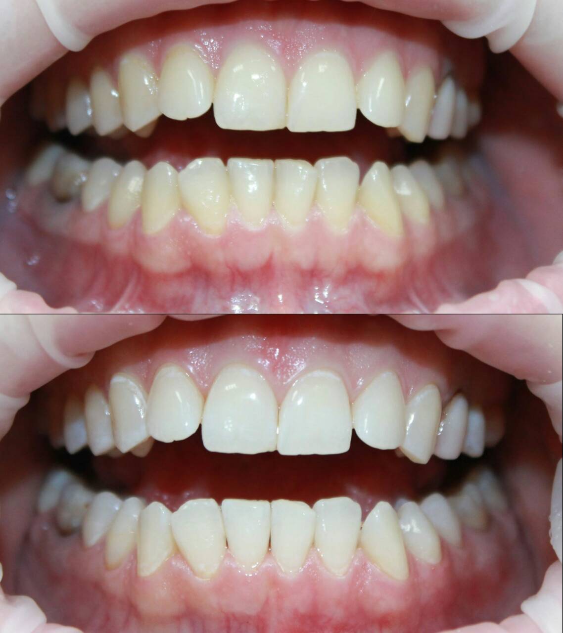 отбеливание зубов при клиновидном дефекте